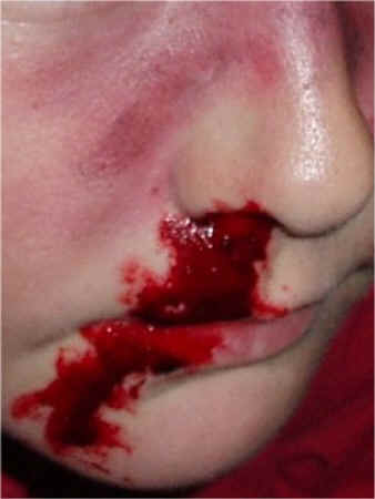 Special_Effects_BrokenNoseDetail.JPG (56336 bytes)