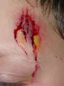 Special Effects: Close up view of boy's left temple showing an extremely realistic synthetic weeping graze. Casualty simulation of this nature is employed for both practical first aid training and in theatrical makeup. Television, theatre and the film industry use our techniques. For medical training Cool Faces can provide realistic artificial burns, cuts, grazes and other injuries, as required.